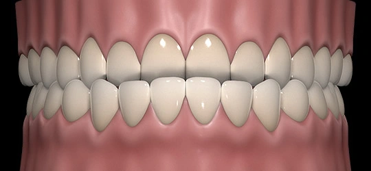 3D realistic rendering of underbite